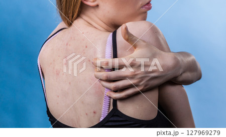 Woman with skin problem acne on back 127969279