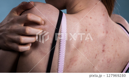 Woman with skin problem acne on back 127969280