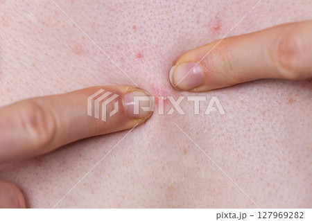Woman dealing with pimples red spots 127969282
