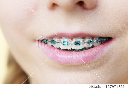 Closeup of woman teeth with braces 127971731