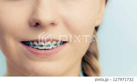 Woman showing her teeth with braces 127971732