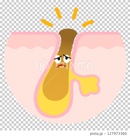 Pores clogged with keratin plugs character 127973360