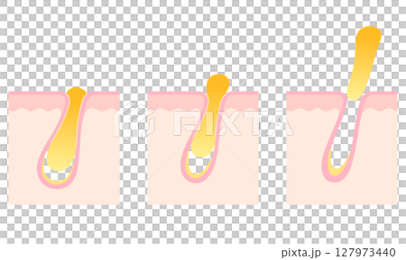 角栓の詰まった毛穴　断面図 127973440