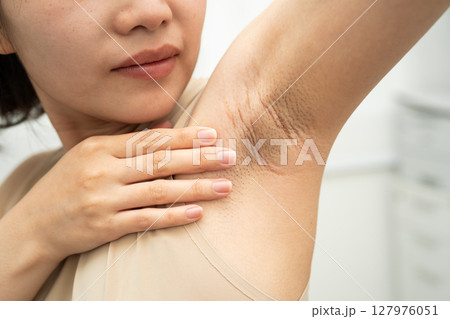 Asian woman have problem black armpit beauty skin care. 127976051