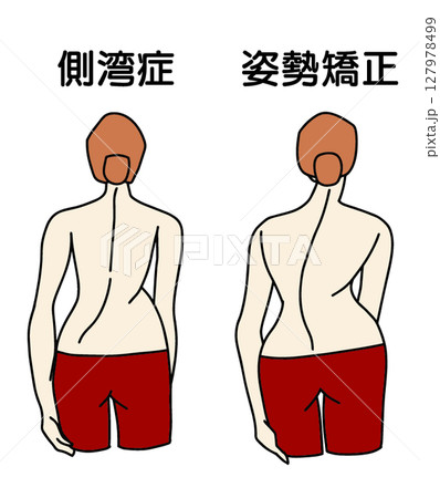 s字側湾症の姿勢を背中から見た時の女性イラスト 127978499