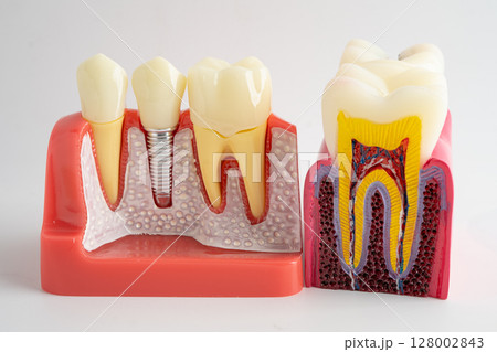 Dental implant, artificial tooth roots into jaw, root canal of dental treatment, gum disease, teeth model for dentist studying about dentistry. 128002843