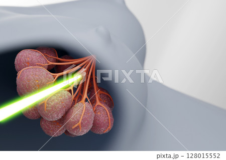 乳がんの放射線治療イメージ 腫瘍を狙うレーザーの3DCG 乳がんの放射線治療イメージ 腫瘍を狙うレーザーの3DCG 128015552