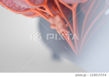 乳房に発生した乳がんの腫瘍イメージ 3DCGイラスト 128015554