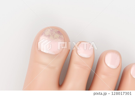 爪水虫の足を上から見た症状のイメージイラスト リアルな3DCG 128017301