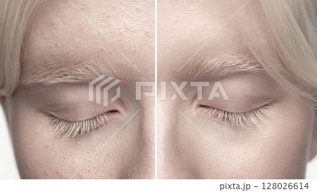 Albino woman skin macro comparison: before and after beauty skin retouch. Dermatology procedure 128026614