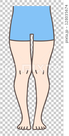 XO脚、複合型脚変形、女性の下肢 XO脚、複合型脚変形、女性の下肢 128035674