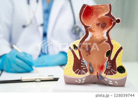 Asian doctor with rectum and hemorrhoid human anatomy model at hospital, inflamed vascular structure. 128039744
