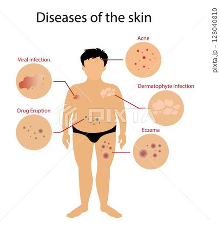 illustration of biology and medical, Diseases of the skin, Skin disorders vary greatly in symptoms and severity, Pictures of different skin disorders, Chronic skin disease illustration of biology and medical, Diseases of the skin, Skin disorders vary greatly in symptoms and severity, Pictures of different skin disorders, Chronic skin disease 128040810
