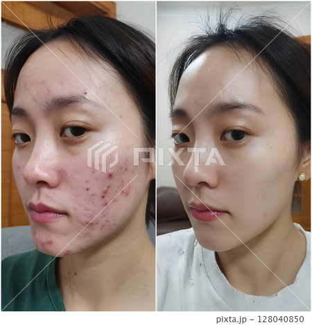 ニキビ治療前後の比較。日本人、韓国人女性の肌改善ビフォーアフター ニキビ治療前後の比較。日本人、韓国人女性の肌改善ビフォーアフター 128040850