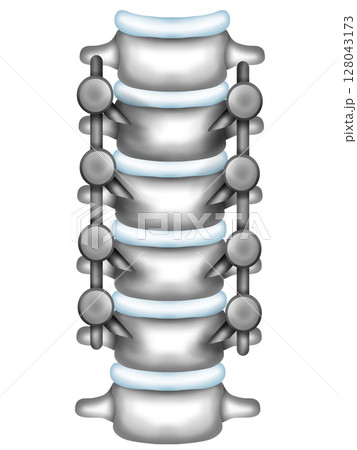 Scoliosis correction surgery using spinal instrumentation 128043173