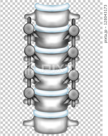 Scoliosis correction surgery using spinal instrumentation 128043173