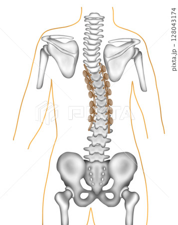 Scoliosis correction surgery using spinal instrumentation Scoliosis correction surgery using spinal instrumentation 128043174