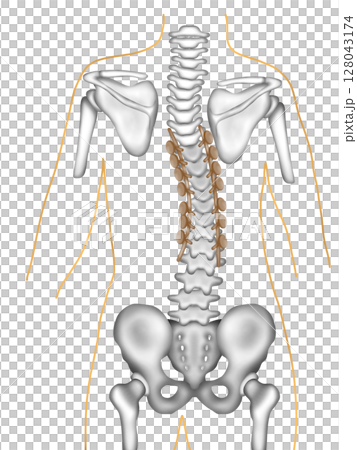 Scoliosis correction surgery using spinal instrumentation Scoliosis correction surgery using spinal instrumentation 128043174