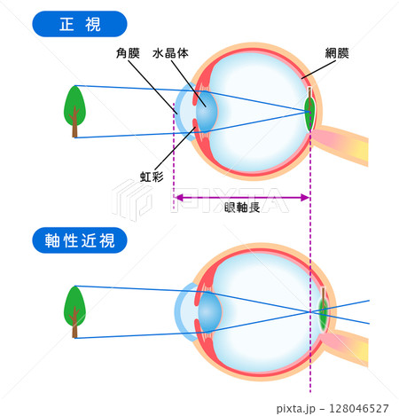 目の構造　正視と軸性近視　視力 128046527