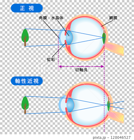 目の構造　正視と軸性近視　視力 128046527