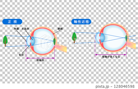 Structure of the eye: normal vision and axial myopia, visual acuity Structure of the eye: normal vision and axial myopia, visual acuity 128046598