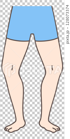 Bow-leggedness, external rotation of the legs Bow-leggedness, external rotation of the legs 128073374