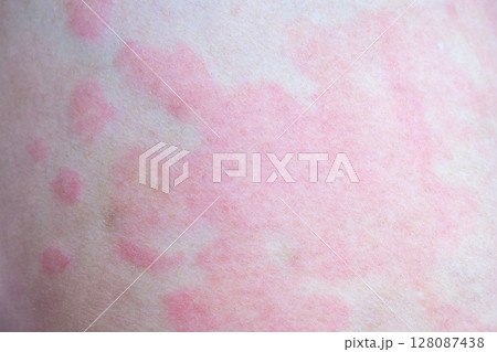 Skin allergy rash dermatitis texture close up 128087438