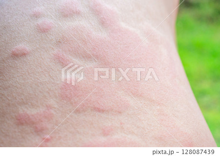 Skin allergy rash dermatitis texture close up Skin allergy rash dermatitis texture close up 128087439