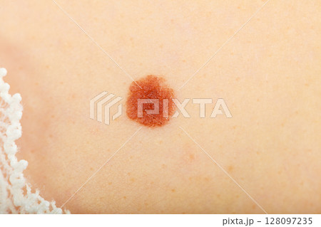 Closeup brown mole on caucasian woman skin. 128097235