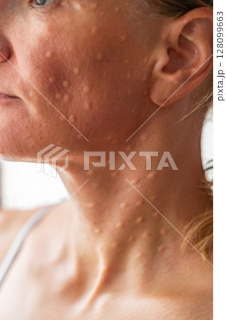 Woman's face after mesotherapy injections biorevitalization. Woman's face after mesotherapy injections biorevitalization. 128099663