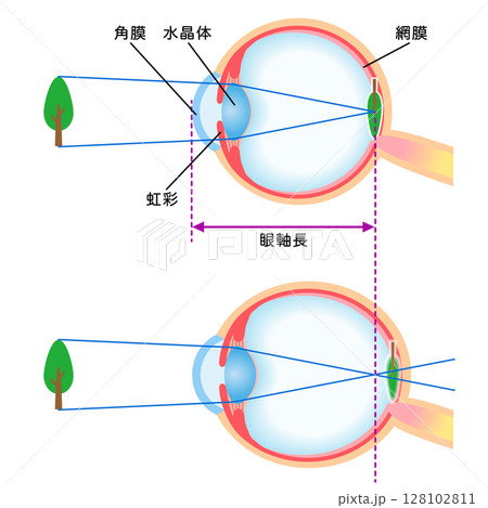 目の構造　正視と軸性近視　視力 128102811