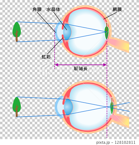 目の構造　正視と軸性近視　視力 128102811