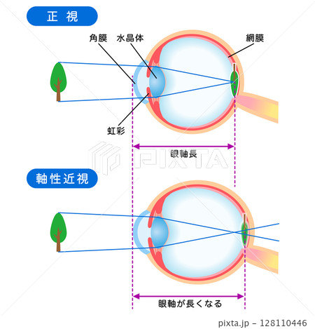 目の構造　正視と軸性近視　視力 128110446