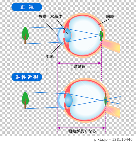 Structure of the eye: normal vision and axial myopia, visual acuity 128110446