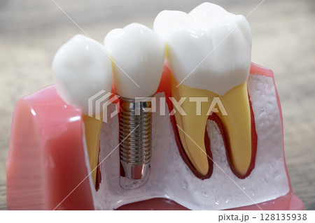 インプラント インプラント 128135938