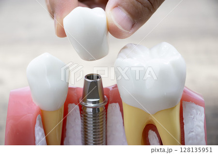 インプラント 128135951