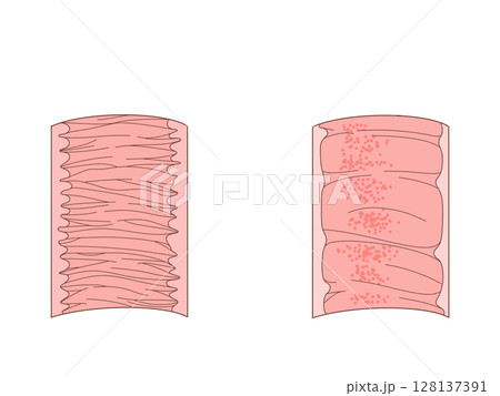 消化器の解剖生理　空腸と回腸の輪状ひだ　文字なし 128137391