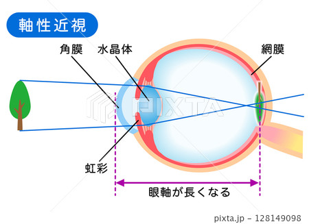 目の構造　軸性近視　視力 128149098