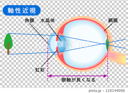 眼睛的結構、軸心近視、視力 128149098