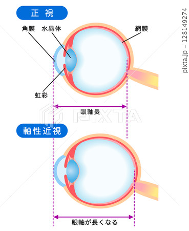 目の構造　正視と軸性近視　視力 128149274
