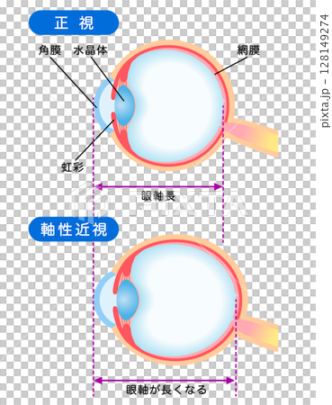 目の構造　正視と軸性近視　視力 128149274