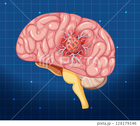 Vector Illustration of Brain with Cancer Cell Vector Illustration of Brain with Cancer Cell 128179146
