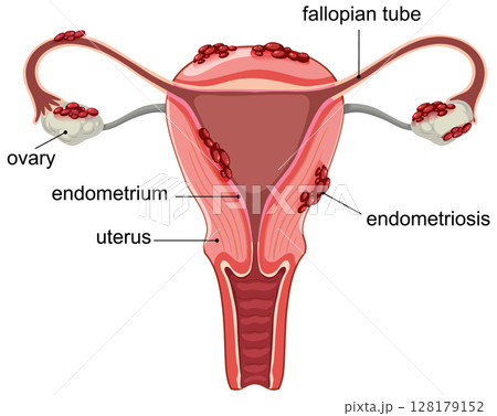Detailed Medical Illustration of Endometriosis in Uterus Detailed Medical Illustration of Endometriosis in Uterus 128179152
