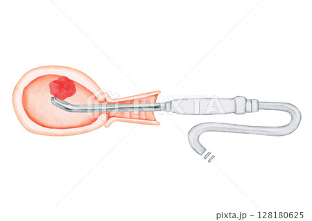 流産 中絶 手術 EVA 自動吸引法 水彩 イラスト 流産 中絶 手術 EVA 自動吸引法 水彩 イラスト 128180625