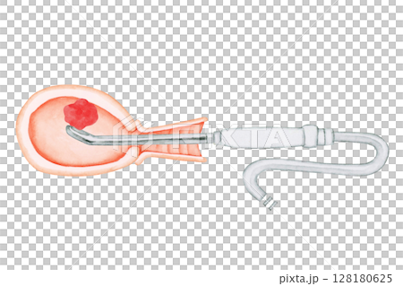 流産 中絶 手術 EVA 自動吸引法 水彩 イラスト 流産 中絶 手術 EVA 自動吸引法 水彩 イラスト 128180625