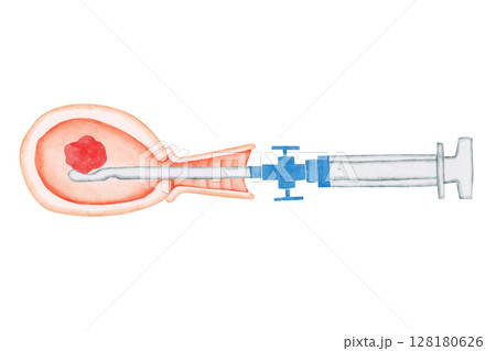 流産 中絶　手術 MVA 手動真空吸引法　水彩 イラスト 128180626
