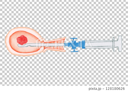 流産 中絶　手術 MVA 手動真空吸引法　水彩 イラスト 128180626