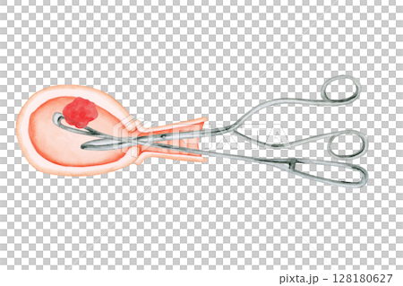 Miscarriage Abortion Surgery Curettage Watercolor Illustration Miscarriage Abortion Surgery Curettage Watercolor Illustration 128180627