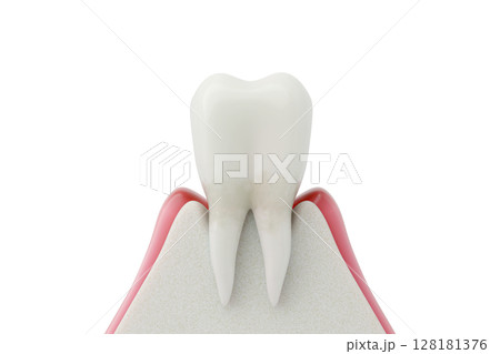 歯周病の初期症状 炎症を起こした歯肉炎の3DCGイラスト 128181376