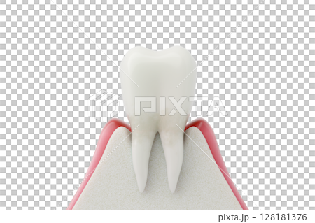 歯周病の初期症状 炎症を起こした歯肉炎の3DCGイラスト 128181376
